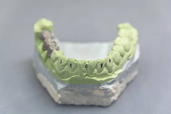Modèle Plâtre Implant Dentaire Vert Avec Pont Métallique Sur Table — Photo