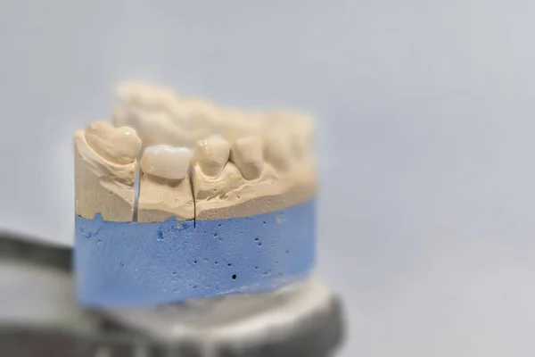 Motif Plâtre Dentaire Céramique Sur Une Table Grise — Photo