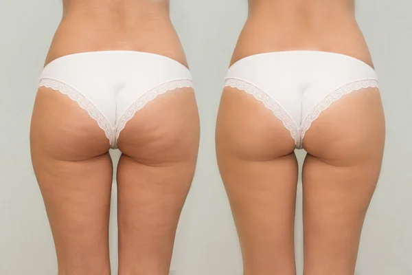 Nalgas femeninas antes y después de la comparación del tratamiento Fotos De Stock