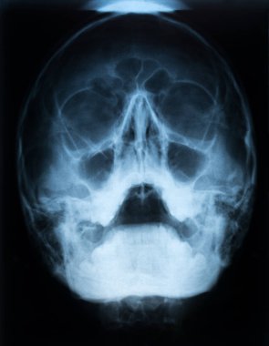 Xray film bir kafatası olan bir hastanın paranazal sinüs hava sıvı seviyesi ile sağ üst akut sinüzit ile