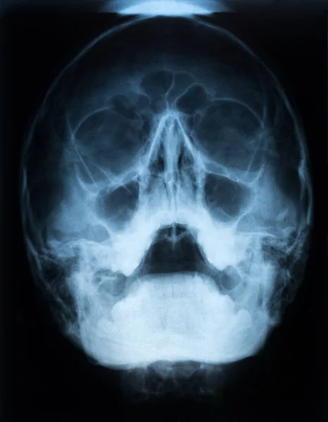 Pellicola Raggi Cranio Paziente Con Seno Paranasale Con Sinusite Mascellare — Foto Stock