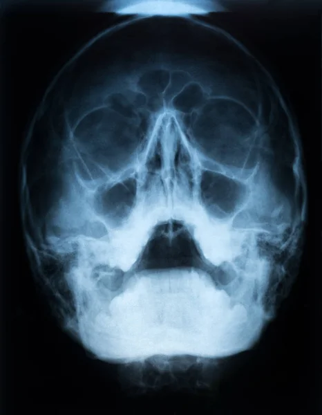 Xray Film Skalle Patient Med Paranasal Sinus Med Akut Höger — Stockfoto