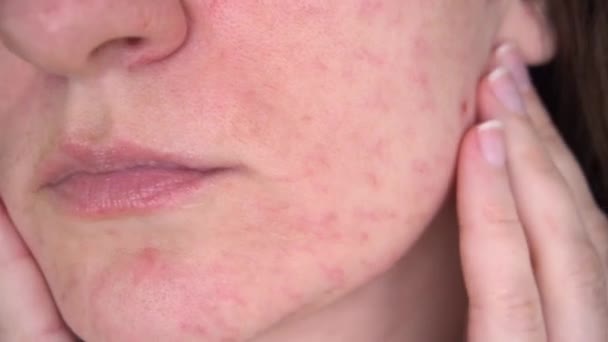 A problémás bőrű fiatal nő ránéz az arcára. Allergiás reakció élelmiszer-intolerancia akne és a bőr károsodása, retusálás nélkül közelkép — Stock videók