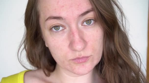 Молодая женщина с проблемной кожей смотрит на свое лицо. Аллергическая реакция пищевая непереносимость акне и повреждений кожи, без ретуши — стоковое видео