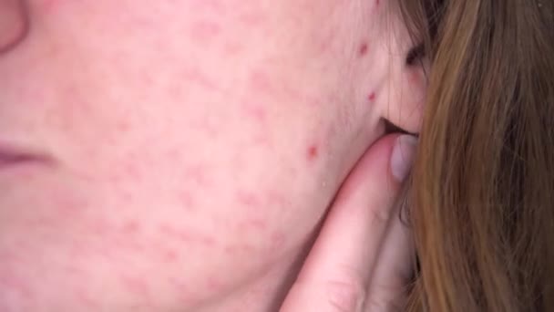 Junge Frau mit Problemhaut blickt in ihr Gesicht. Allergische Reaktion Nahrungsmittelunverträglichkeit auf Akne und Hautschäden, ohne Nahaufnahme zu retuschieren — Stockvideo
