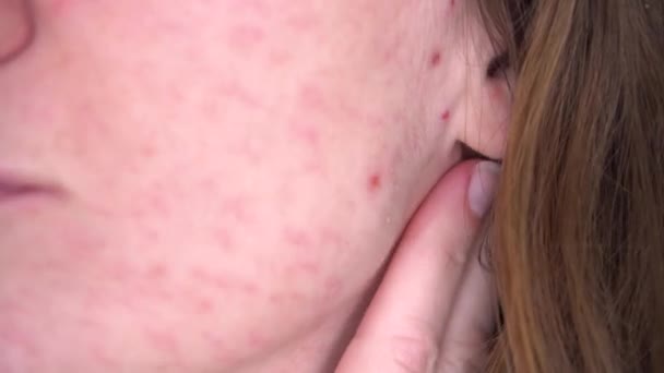 Giovane donna con la pelle problema guarda il suo viso. Reazione allergica intolleranza alimentare ad acne e danni alla pelle, senza ritocco primo piano — Video Stock