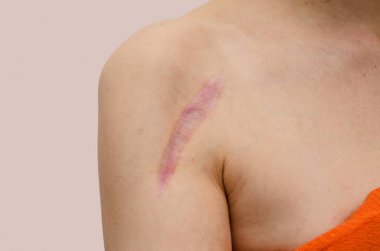 Close up of female shoulder with a scar after install a metal pl clipart