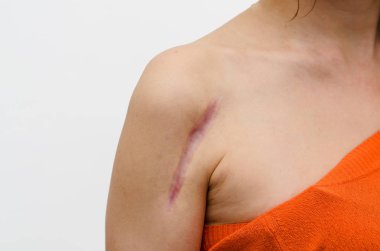 Cerrahi bir metal plaka kemik kırığı taktıktan sonra bir yara ile kadın omuz kapatın. Yaraların iyileşmesi