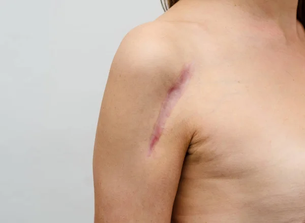 Close up of female shoulder with a scar after install a metal pl — Stock Photo, Image