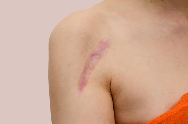 Nahaufnahme der weiblichen Schulter mit einer Narbe nach der Installation eines Metallpl — Stockfoto
