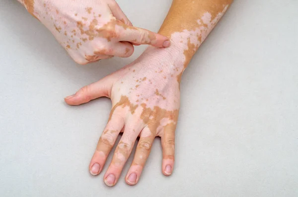 Vitiligo na pele das mãos. Dedo indica defeito de pele — Fotografia de Stock