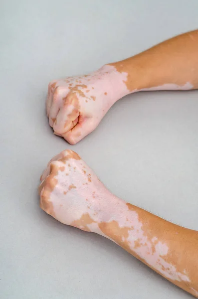 Vitiligo on the skin of hands. Brush clenched in fists