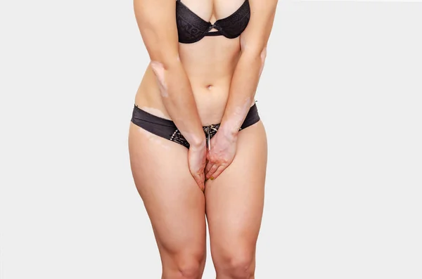 Kvinna med kraftfulla höfter i underkläder upplevelser smärta, obehag i bikini zonen, Vagina, mage. Gynekologisk sjukdom, urin, måste kissa. Vitiligo på huden. — Stockfoto