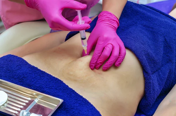 女性の腹部に注射器注射器を作る紫色のゴム手袋の美容師の手 スムーズな肌 ストレッチマークと戦う 化粧品の手続き — ストック写真