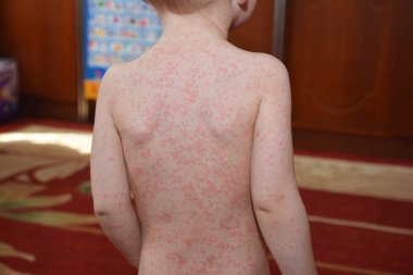 Enfeksiyöz Mononükleoz (IM, mono), olarak da bilinen glandular fever, herpesvirus genellikle Epstein - Barr virüsü (Ebv tarafından neden olduğu bir enfeksiyondur).