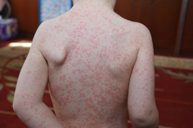 Enfeksiyöz Mononükleoz (IM, mono), olarak da bilinen glandular fever kapatın, herpesvirus genellikle Epsteinbarr virüs (Ebv tarafından neden olduğu bir enfeksiyondur).