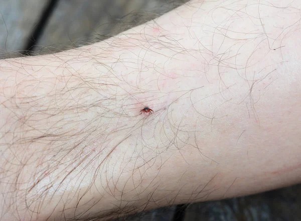 Man Has Deer Black Legged Tick Bite Ixodes Scapularis Bite — Stock Photo, Image