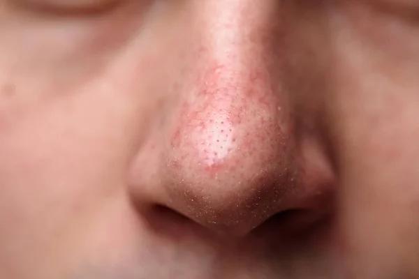 Demodicosis ile erkek burun close-up. Sorun cilt.