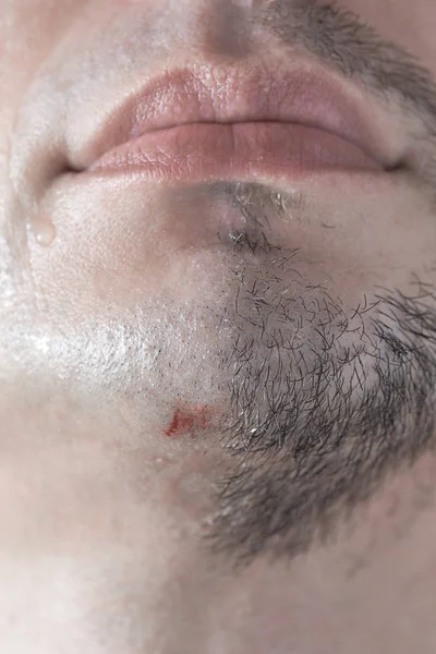 A cut on a mans chin from a sloppy shave. — Stock Photo, Image