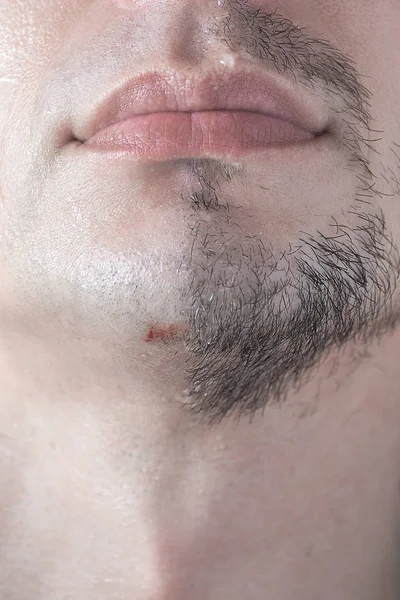 A cut on a mans chin from a sloppy shave. — Stock Photo, Image