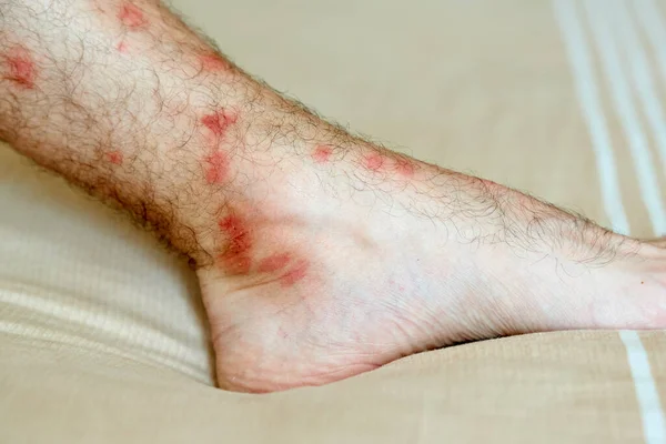 Male leg with many red spot and scar from insect bite. Allergic reaction to insect bites. — Stock Photo, Image