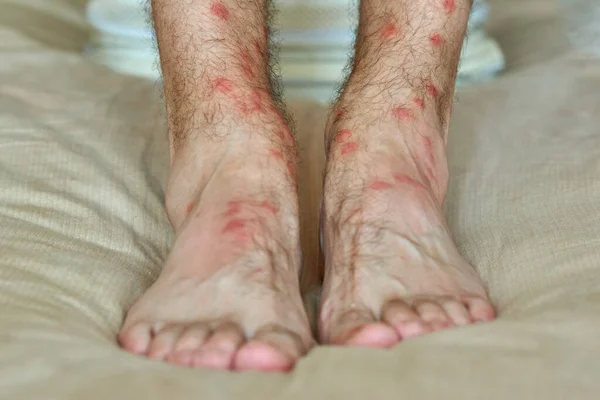 Male legs with many red spot and scar from insect bite. — Stock Photo, Image