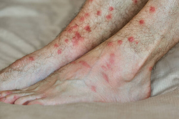 Male feet with many red spot and scar from insect bite. Severe irritation on the skin.