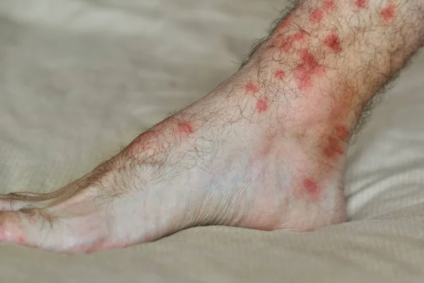 Allergic reaction to insect bites. Male foot with many red spot and scar from insect bite. — Stock Photo, Image