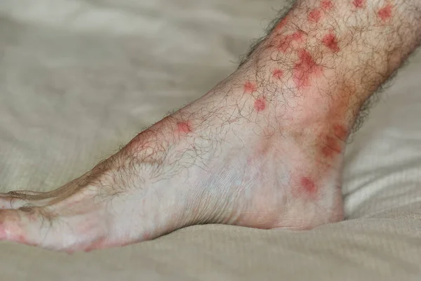Manchas vermelhas na pele. Perna masculina com muitos pontos vermelhos e cicatriz de picada de inseto. — Fotografia de Stock