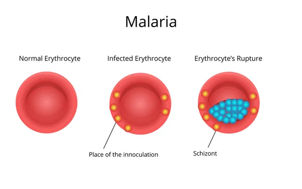 疟疾感染的发展 正常红细胞与受感染的血细胞 — 图库矢量图片