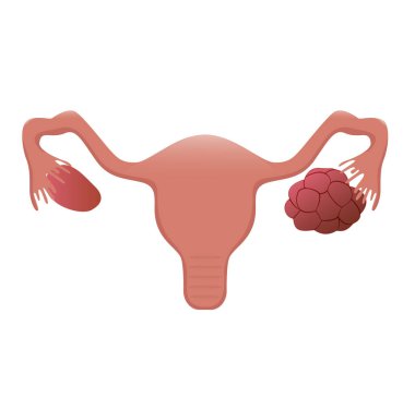 Illustration of the womb with a polycystic ovary clipart
