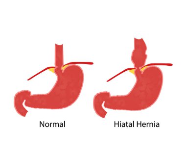 Hiatal hernia and normal anatomy of the stomach and esophagus vector illustration clipart