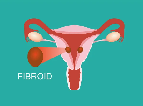 Illustrazione Del Fibroma Uterino Anatomia Del Grembo Materno — Vettoriale Stock