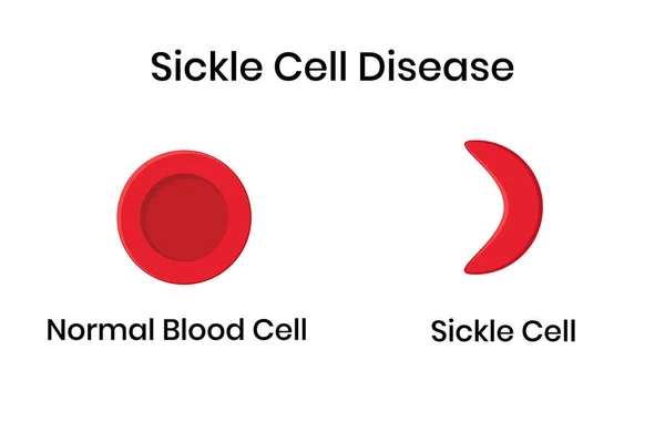镰状细胞贫血 正常红细胞对变形镰状细胞的危害 — 图库矢量图片