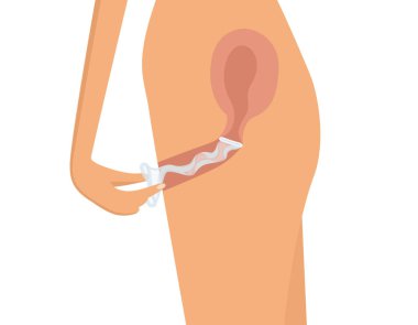 Kadın prezervatif çekilmesi