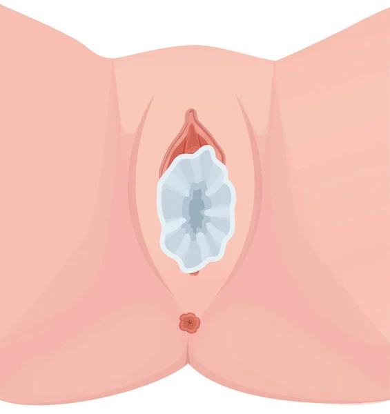 Condón femenino en la vagina — Vector de stock