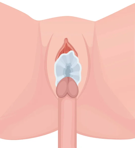 Safe sex. Protected intercource. Female condom into vagina — Stockvector