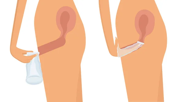 Insertion de préservatif féminin dans le vagin — Image vectorielle