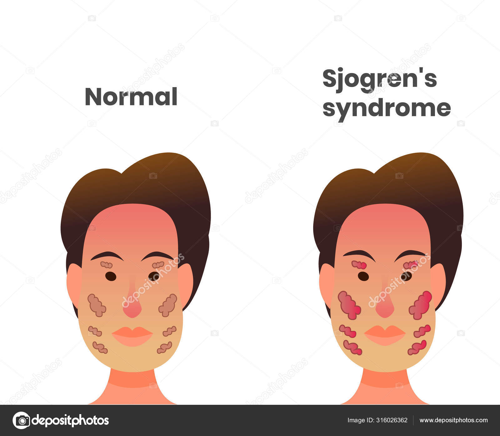 Normal lacrimal and salivary gland versus sjogren's syndrome Stock