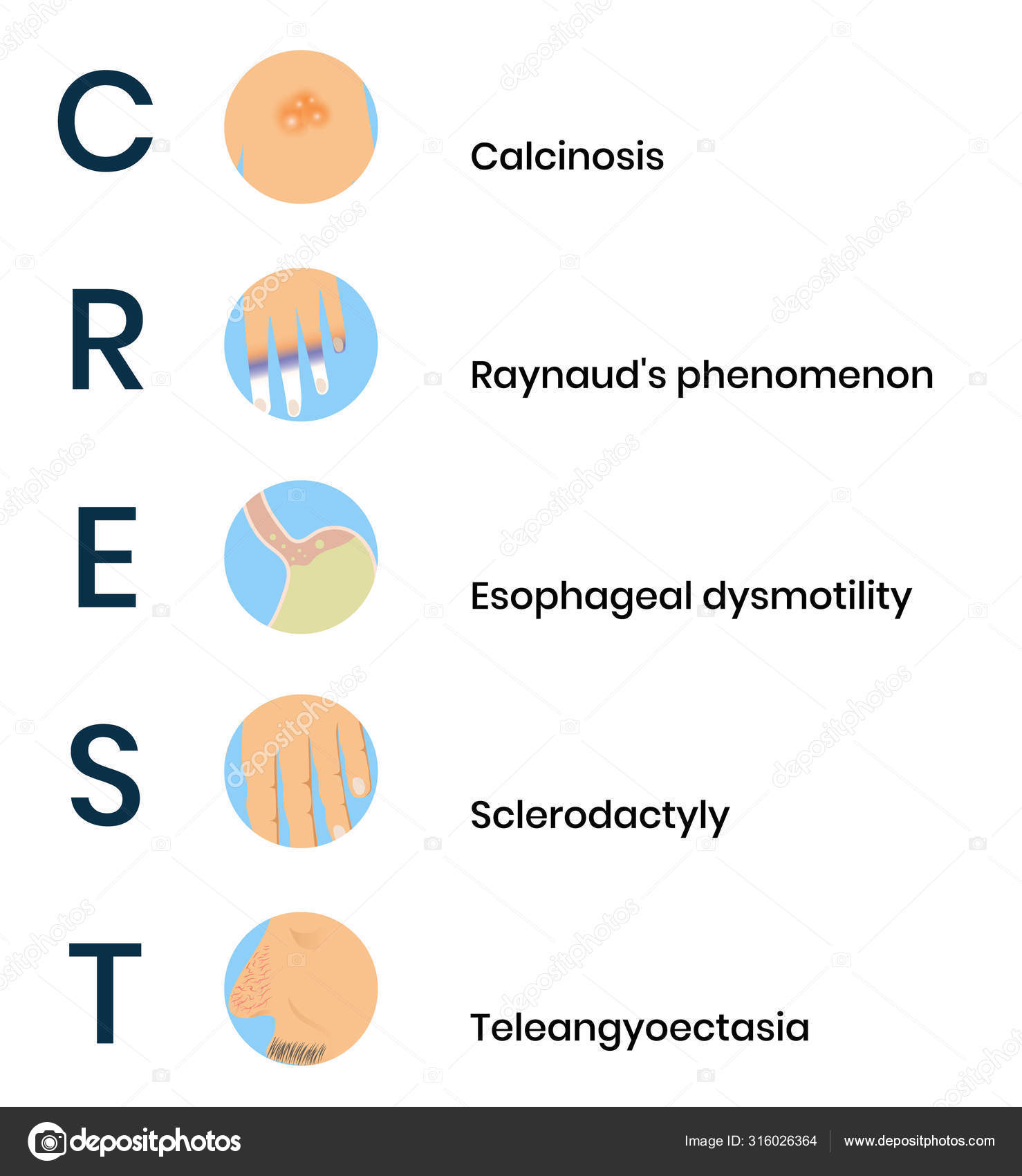 Клинические синдромы при системной склеродермии. Системная склеродермия крест синдром. Системная склеродермия crest. Крест при системной склеродермии. Синдромы при системной склеродермии.