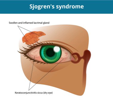 Sjogren's syndrome or dry eye syndrome. Keratoconjuctivitis sicc clipart