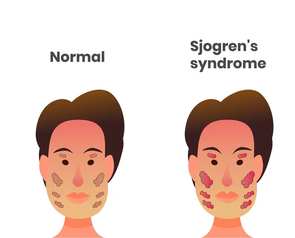 Нормальные слёзные железы и слюнные железы против синдрома Шегрена — стоковый вектор