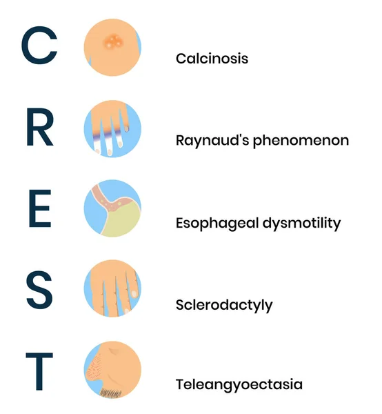 Crest syndrom ikony. Symptomy systémové sklerózy — Stockový vektor