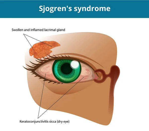 Syndrome de Sjogren ou syndrome des yeux secs. Keratoconjuctivitis sicc — Image vectorielle