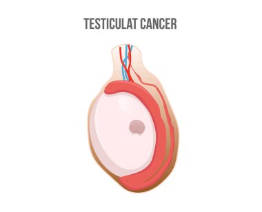 Testis kanseri vektör çizimi. Tümörlü bir testis klipsi.