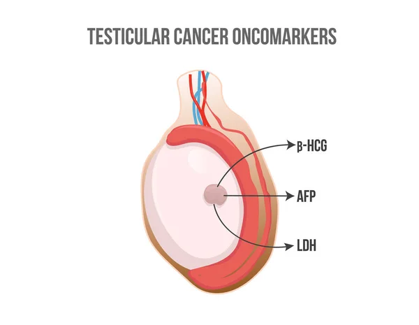 腫瘍マーカーを検査する 非セミノーマがんのマーカーと考えられているホルモンや酵素を放出する精巣がん — ストックベクタ