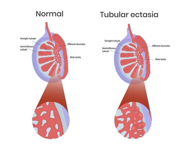 正常睾丸解剖学对睾丸管状扩张的研究 囊性睾丸病理学的矢量图解 — 图库矢量图片