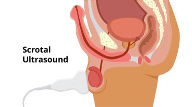 Testis ultrason taraması. Erkek üreme sistemi anatomisi ve muayenesi. Doğrusal sonda testis üzerine yerleştirilir