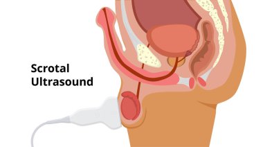 Scrotal ultrasound scan process. Male roproductive system anatomy and examination. Linear probe is placed on the testis clipart