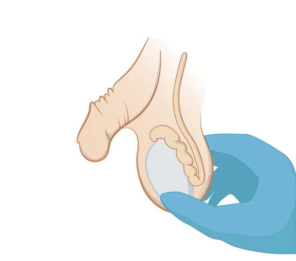 Examen Masa Escrotal Mano Guante Palpa Testículo — Vector de stock